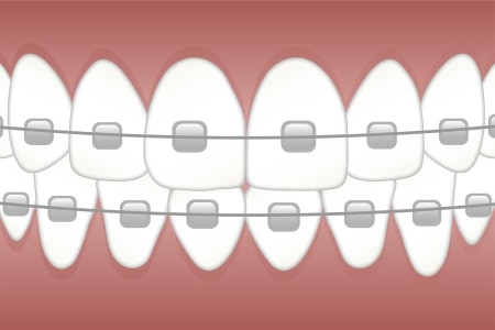 braces-35975911280.jpg